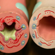 On the left, a model demonstrating the inflamed airway of someone with asthma. A model of a healthy airway is shown at right.